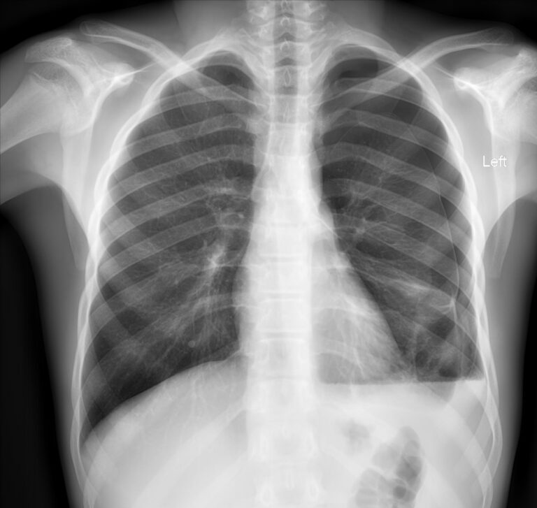 Hydropneumothorax